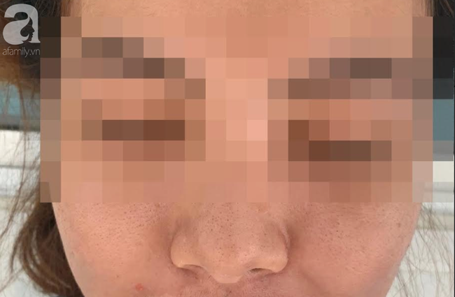 Đắp mặt nạ làm trắng da giá 600.000 đồng, mặt người phụ nữ sưng phù, mụn mủ nhiều kinh khủng - Ảnh 2. Đắp mặt nạ làm trắng da giá 600.000 đồng, mặt người phụ nữ sưng phù, mụn mủ nhiều kinh khủng - Ảnh 2.