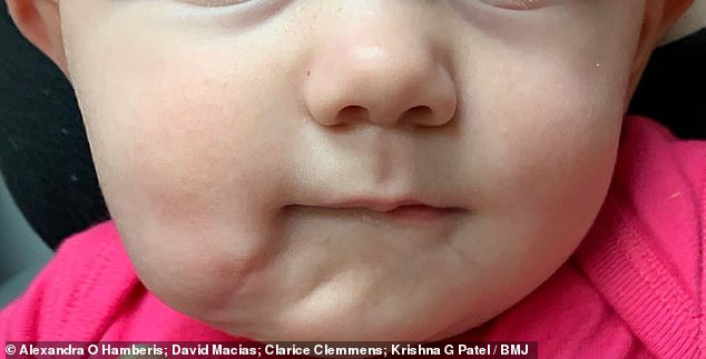 Vừa mới chào đời, bé gái đã khiến các bác sĩ kinh ngạc khi có đến 2 cái miệng trên mặt - bệnh lý vô cùng hiếm gặp - Ảnh 3.
