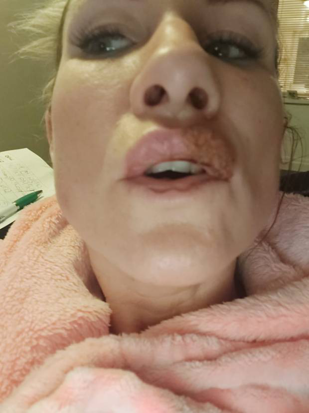 Tăng lượng filler để bơm vào môi cho đầy đặn, người phụ nữ này phải chịu đau đớn đến nỗi không thể ăn và nói suốt 2 năm - Ảnh 2.
