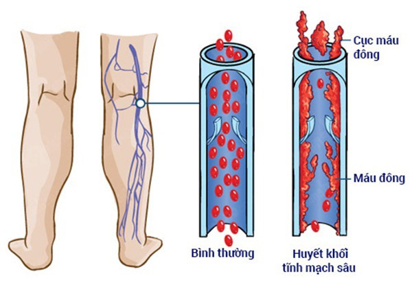 Bất ngờ với loại quả làm biến mất chỗ suy giãn tĩnh mạch có ngay trong nhà bạn - Ảnh 3.