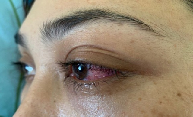Tưởng đau mắt đỏ, bệnh nhân suýt mù vì bệnh rò động mạch màng cứng xoang hang - Ảnh 1.