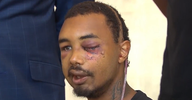 Chàng trai bị cảnh sát bắn mù mắt giữa biểu tình ở Mỹ - Ảnh 1.