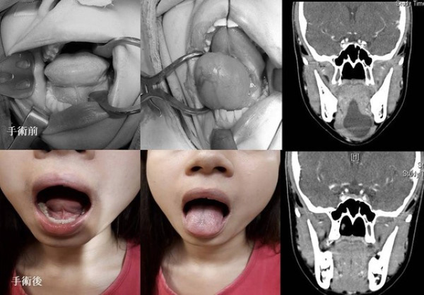 Cô gái nói chuyện không ai hiểu, đi khám phát hiện có khối u to bất thường - Ảnh 1. Cô gái nói chuyện không ai hiểu, đi khám phát hiện có khối u to bất thường - Ảnh 1.