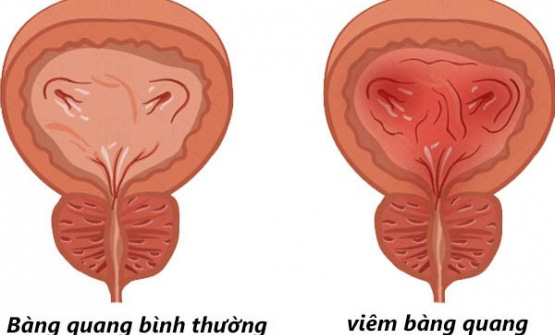 Viêm bàng quang tái phát có nguy cơ gì? - Ảnh 1.