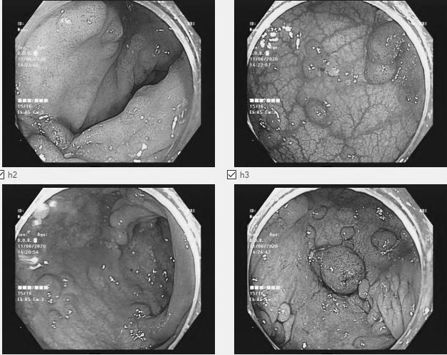 Hơn 100 polyp trong ruột người phụ nữ - Ảnh 1.