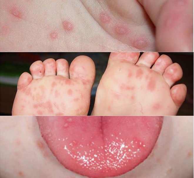 Sốt cao không hạ: BS Bệnh viện Nhi khuyến cáo có thể là dấu hiệu tay-chân-miệng nặng - Ảnh 1. Sốt cao không hạ: BS Bệnh viện Nhi khuyến cáo có thể là dấu hiệu tay-chân-miệng nặng - Ảnh 1.