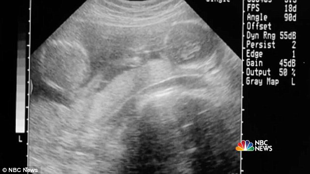 2 con gái sinh đôi dính liền, cha mẹ mất 7 tháng mới quyết định tách rời con, 17 năm sau ai cũng mãn nguyện khi thấy nụ cười của các em - Ảnh 1. 2 con gái sinh đôi dính liền, cha mẹ mất 7 tháng mới quyết định tách rời con, 17 năm sau ai cũng mãn nguyện khi thấy nụ cười của các em - Ảnh 1.