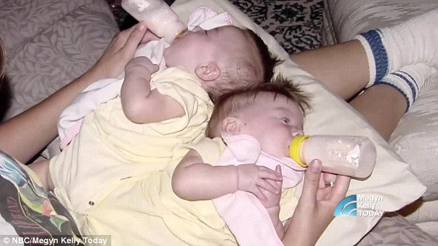 2 con gái sinh đôi dính liền, cha mẹ mất 7 tháng mới quyết định tách rời con, 17 năm sau ai cũng mãn nguyện khi thấy nụ cười của các em - Ảnh 3.