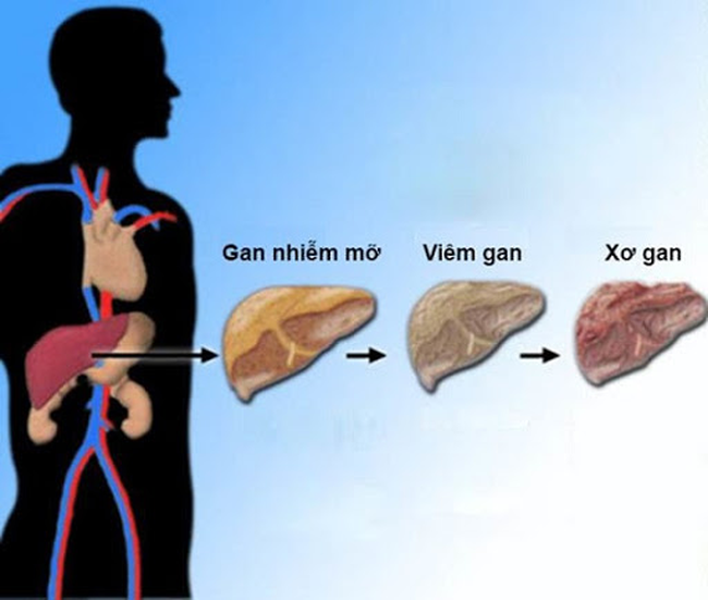 Hai căn bệnh cực kỳ phổ biến và rất dễ phát triển thành ung thư, bạn cần ngăn chặn ngay từ bây giờ - Ảnh 2. Hai căn bệnh cực kỳ phổ biến và rất dễ phát triển thành ung thư, bạn cần ngăn chặn ngay từ bây giờ - Ảnh 2.