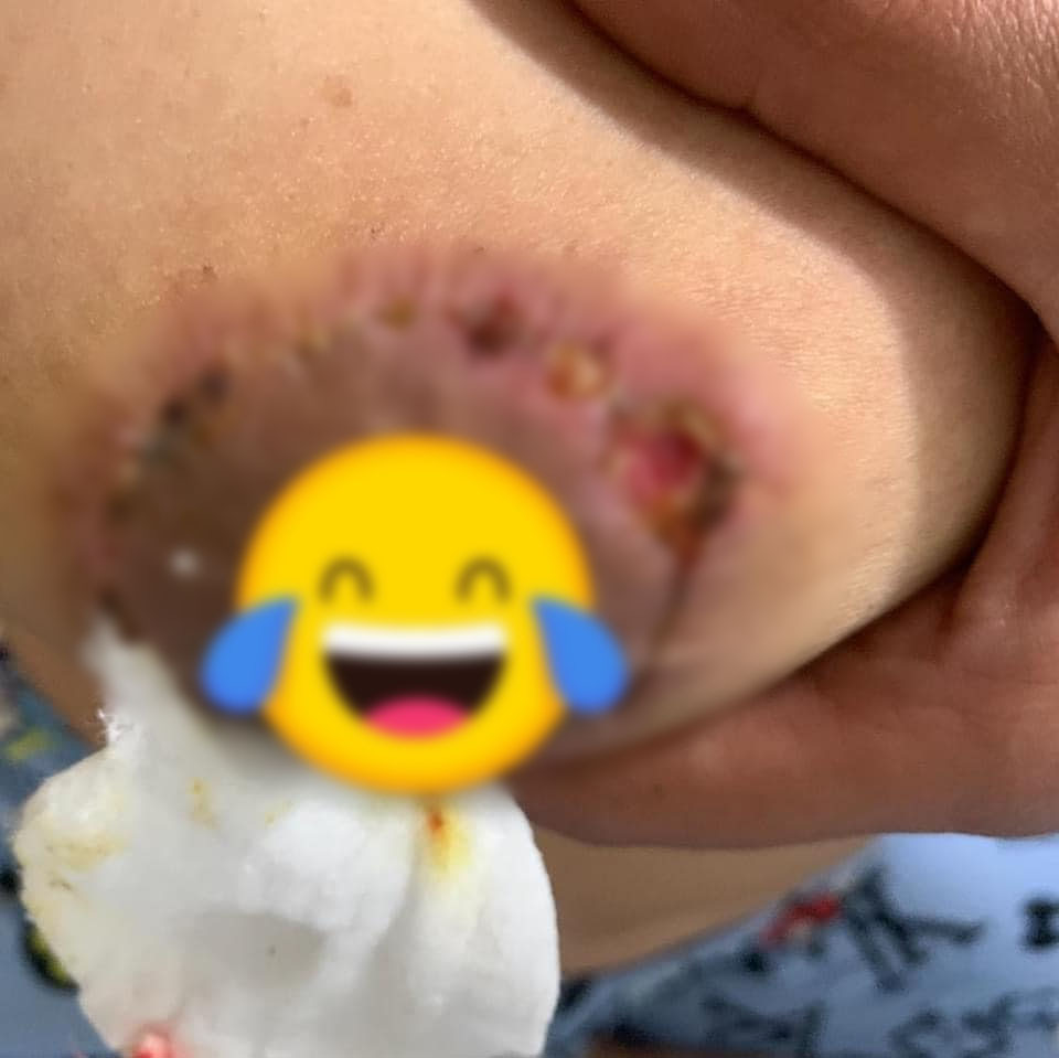 Cô gái trẻ bị lở loét, mưng mủ sau khi thực hiện nâng ngực chảy xệ ở spa chất lượng kém: Bài học đắt giá cho những chị em đang muốn thực hiện! - Ảnh 2. Cô gái trẻ bị lở loét, mưng mủ sau khi thực hiện nâng ngực chảy xệ ở spa chất lượng kém: Bài học đắt giá cho những chị em đang muốn thực hiện! - Ảnh 2.