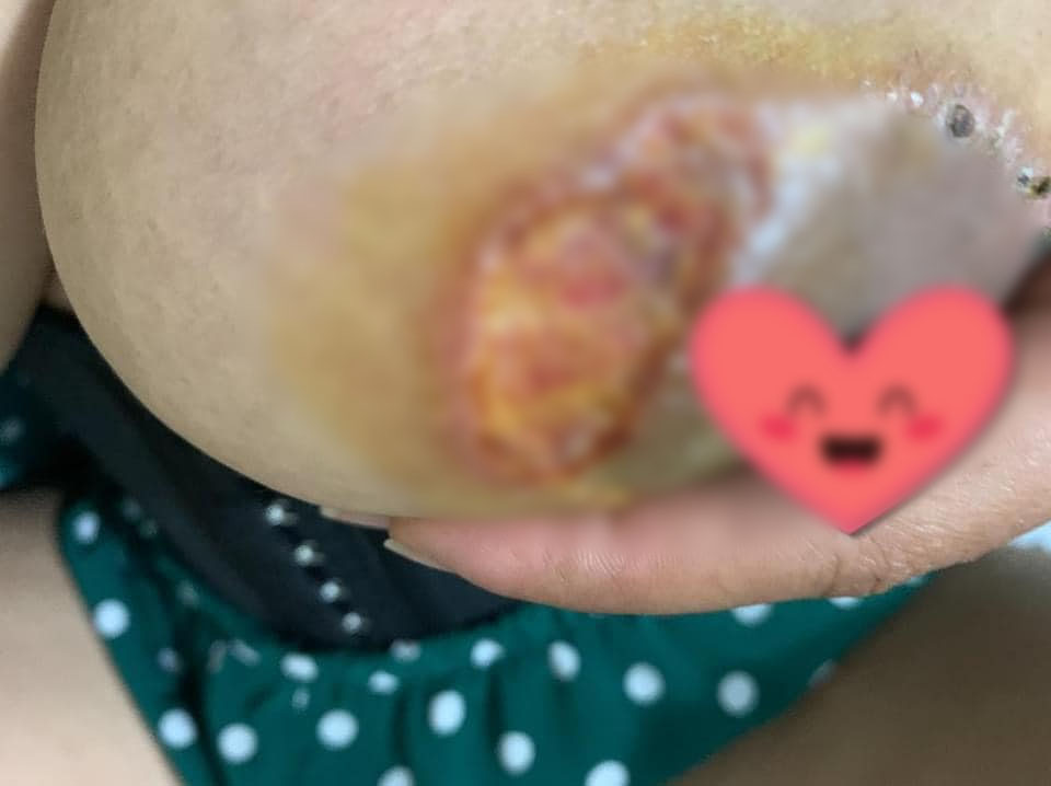 Cô gái trẻ bị lở loét, mưng mủ sau khi thực hiện nâng ngực chảy xệ ở spa chất lượng kém: Bài học đắt giá cho những chị em đang muốn thực hiện! - Ảnh 3. Cô gái trẻ bị lở loét, mưng mủ sau khi thực hiện nâng ngực chảy xệ ở spa chất lượng kém: Bài học đắt giá cho những chị em đang muốn thực hiện! - Ảnh 3.