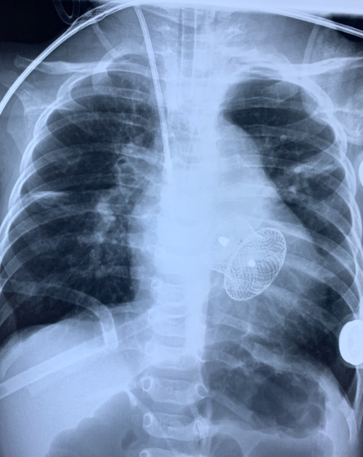 Bé 5 tháng tuổi viêm phổi kéo dài vì dị tật ở tim - Ảnh 2.