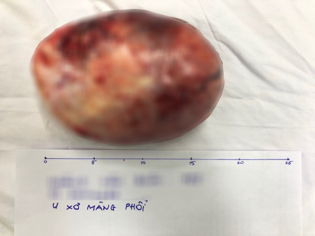 Phát hiện khối u hiếm trong lồng ngực sau 2 tháng nhói đau khi nằm nghiêng - Ảnh 2.