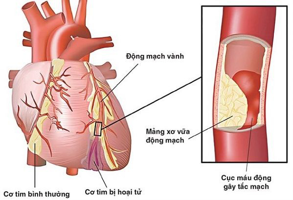 Chàng trai 25 tuổi đột tử trong đêm tân hôn, bác sĩ chỉ rõ nguyên nhân được chiều chuộng từ thói quen ăn uống - Ảnh 2.