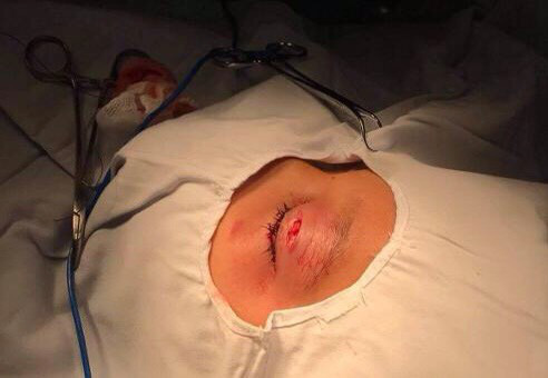 Bé trai 9 tuổi bị ghi đông xe đâm vào mắt - Ảnh 1.