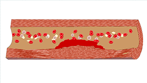 8 bức ảnh sinh động tiết lộ toàn bộ quá trình tắc nghẽn mạch máu - nguyên nhân có thể dẫn đến các bệnh gây tử vong - Ảnh 8.
