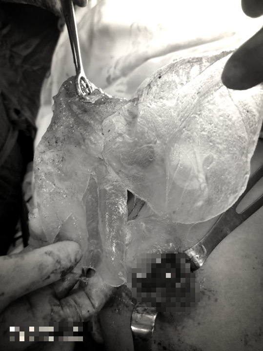 Người phụ nữ ở Hà Nội vỡ túi ngực silicon kèm khối u  - Ảnh 1.