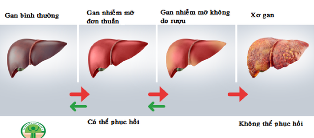 Từ vụ bé trai mới 8 tuổi đã bị gan nhiễm mỡ, chuyên gia chỉ rõ 5 nguyên nhân chính gây bệnh ở trẻ - Ảnh 2.