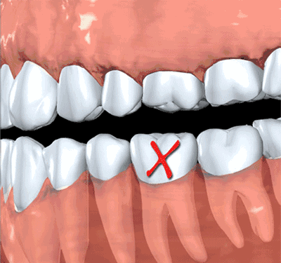 Người đàn ông 31 tuổi đi khám vì răng lung lay, bác sĩ quyết định nhổ tất cả răng vì sai lầm từ 2 năm trước của anh - Ảnh 4.