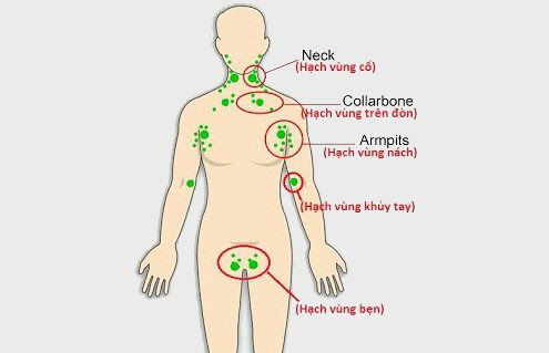 Cụ ông thoát liệt chi vì vết mổ nhỏ ở vùng bẹn - Ảnh 2.