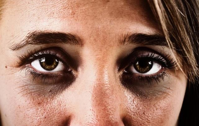 Xuất hiện quầng thâm ở mắt đừng chủ quan, rất có thể bạn đã mắc 1 trong 5 bệnh nguy hiểm này - Ảnh 2.