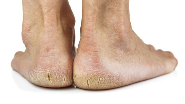 Gót chân thường xuyên bị khô và nứt nẻ, coi chừng sức khỏe đang “kêu cứu” - Ảnh 3.
