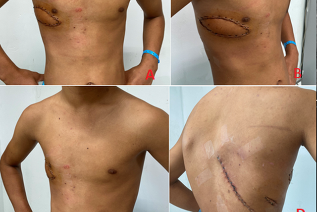 Phẫu thuật thành công khối u thành ngực xâm lấn rộng cho nam bệnh nhân - Ảnh 1.