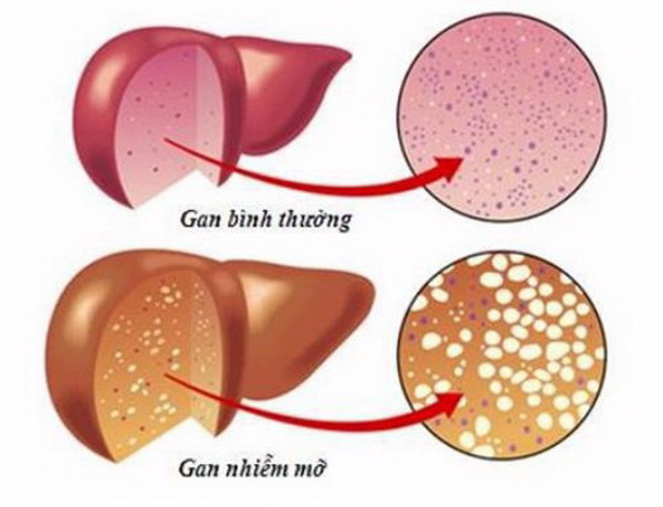  Phòng ngừa bệnh thường gặp ở gan - Ảnh 2.