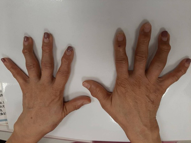 10 ngón tay đau nhức và biến dạng, người phụ nữ điếng người khi bác sĩ thông báo Không có thuốc chữa - Ảnh 1.