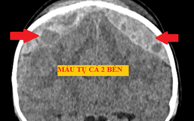 Cưa hộp sọ cứu bé trai xuất huyết não do ngã giường tầng - Ảnh 1.