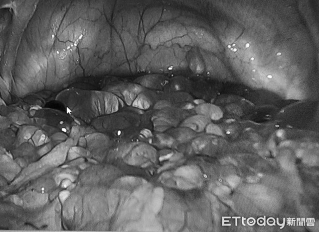 Người phụ nữ nhập viện trong tình trạng chướng bụng, bác sĩ kinh ngạc khi thấy hàng trăm u nang, vớt 2 tiếng 6 túi mới xong - Ảnh 2.