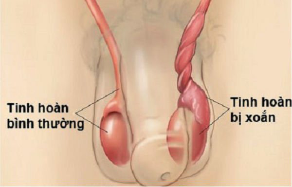  Phát hiện muộn xoắn thừng tinh, người đàn ông phải cắt bỏ tinh hoàn  - Ảnh 1.