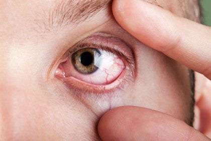 Mắc căn bệnh gây mù lòa chỉ sau đục thủy tinh thể vì bỏ qua dấu hiệu với mắt nhìn mờ - Ảnh 2.
