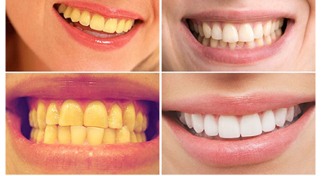 Ngạc nhiên với cách làm răng trắng bóng sạch đơn giản, rẻ tiền mà không phải dùng hóa chất - Ảnh 2.