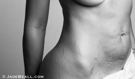 Những bức ảnh x&uacute;c động về cơ thể phụ nữ sau sinh đẻ 3