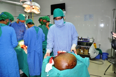 Bóc tách khối u hàng chục kg cho một phụ nữ 4