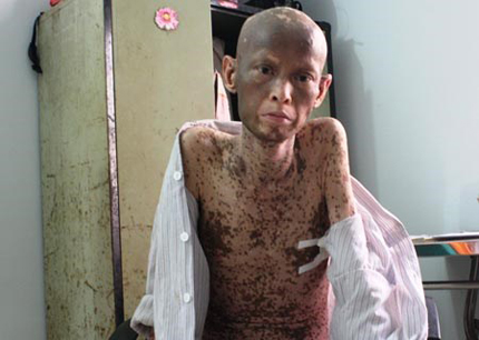 Nghị lực phi thường của người đ&agrave;n &ocirc;ng mắc căn bệnh &ldquo;quỷ &aacute;m&rdquo; 1