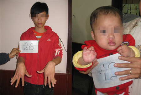 Lạ l&ugrave;ng nơi c&oacute; nhiều người bị d&iacute;nh ng&oacute;n 1