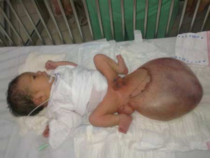 Vì sao xuất hiện dị tật 2 đầu, 4 tay ở trẻ sơ sinh? 1 Vì sao xuất hiện dị tật 2 đầu, 4 tay ở trẻ sơ sinh? 1