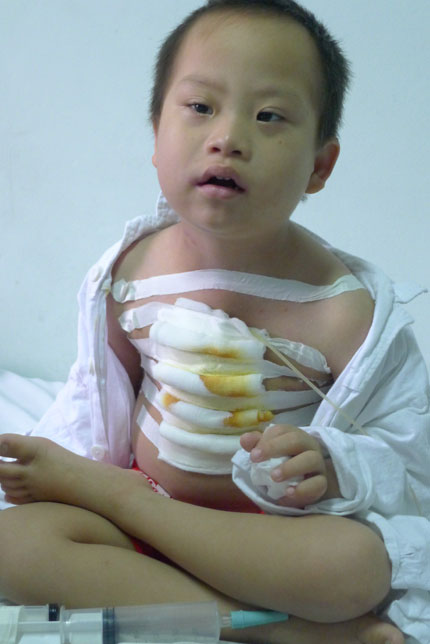 Xót xa bé 5 tuổi mồ côi chờ chết vì nhiễm trùng nặng 1