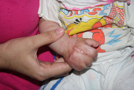Nao lòng ánh mắt trong veo của bé 5 tháng tuổi bị rụng ngón, lở loét khắp cơ thể 5