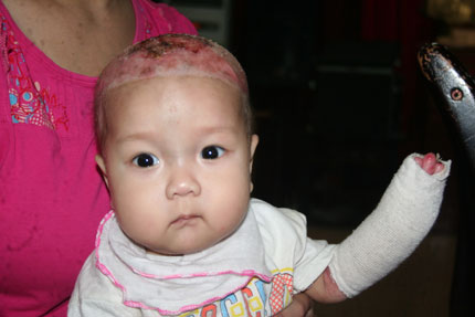 Nao lòng ánh mắt trong veo của bé 5 tháng tuổi bị rụng ngón, lở loét khắp cơ thể 7