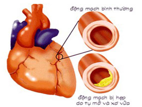 Đau tim, đau thắt ngực – Dấu hiệu nguy hiểm! 1