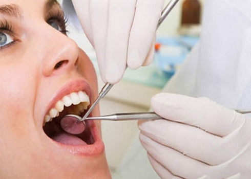 Những điều cần biết về cạo v&ocirc;i răng 1