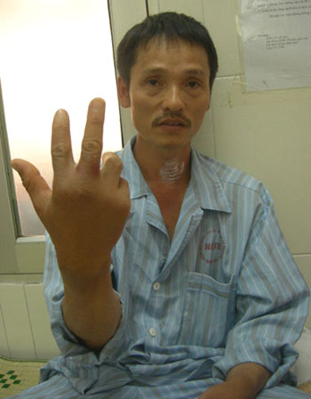 Hà Nội: Bệnh nhân nhập viện vì chuột cắn 1 Hà Nội: Bệnh nhân nhập viện vì chuột cắn 1