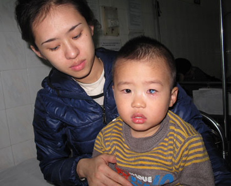 Nghịch gói chống ẩm, bé 2 tuổi bị bỏng mắt 1 Nghịch gói chống ẩm, bé 2 tuổi bị bỏng mắt 1
