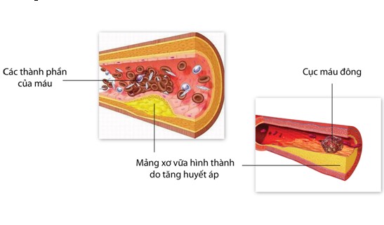 Nguyên nhân số 1 gây tử vong và tàn tật do huyết áp cao 2