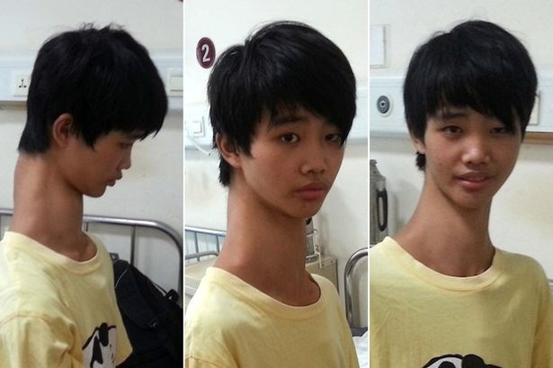 Xót thương cậu bé có chiếc cổ dài như "hươu cao cổ" 1 Xót thương cậu bé có chiếc cổ dài như "hươu cao cổ" 1