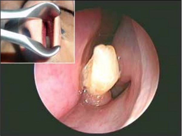 Kinh hoàng khi phát hiện ra chiếc răng dài 1,27 cm mọc trong mũi 1 Kinh hoàng khi phát hiện ra chiếc răng dài 1,27 cm mọc trong mũi 1