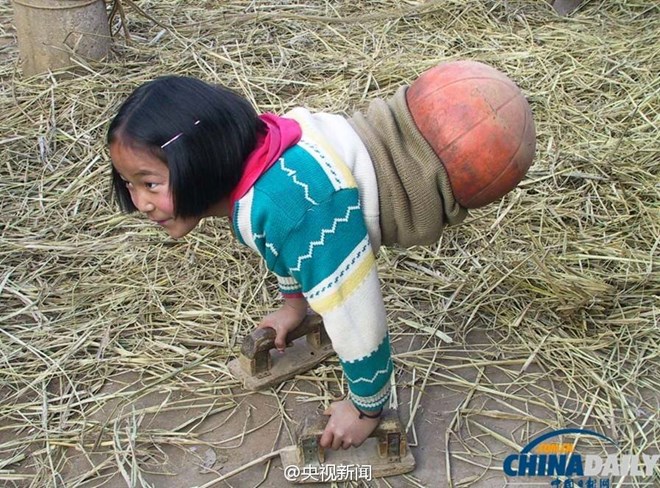 Cảm phục nghị lực tuyệt vời của "c&ocirc; b&eacute; b&oacute;ng rổ" phải cắt bỏ đ&ocirc;i ch&acirc;n 1